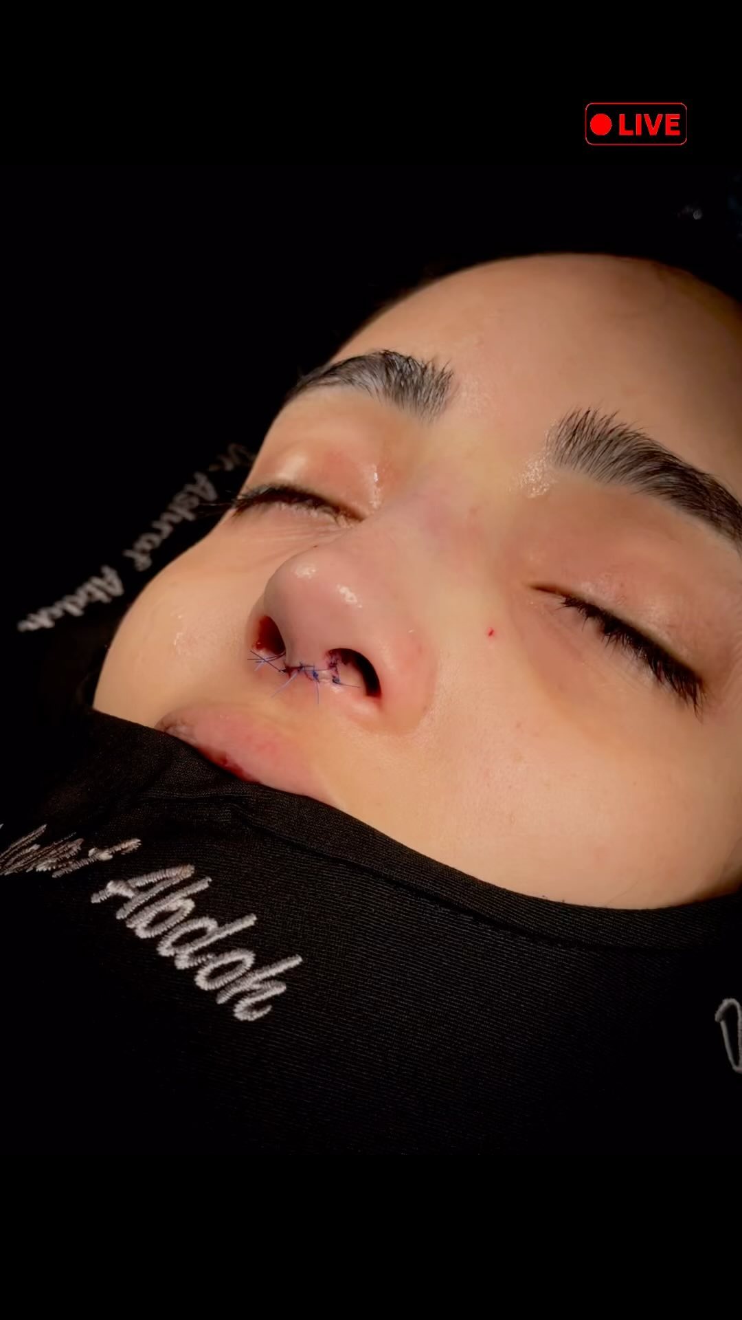 صورة سريرية أمامية لأنف مع غرز